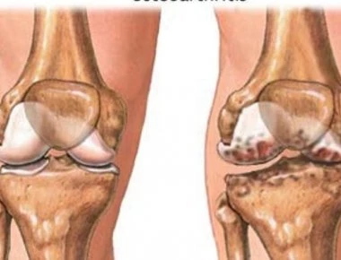 Οστεοαρθρίτιδα ισχίου-γόνατος: Γιατί αυξάνει τον καρδιαγγειακό κίνδυνο;